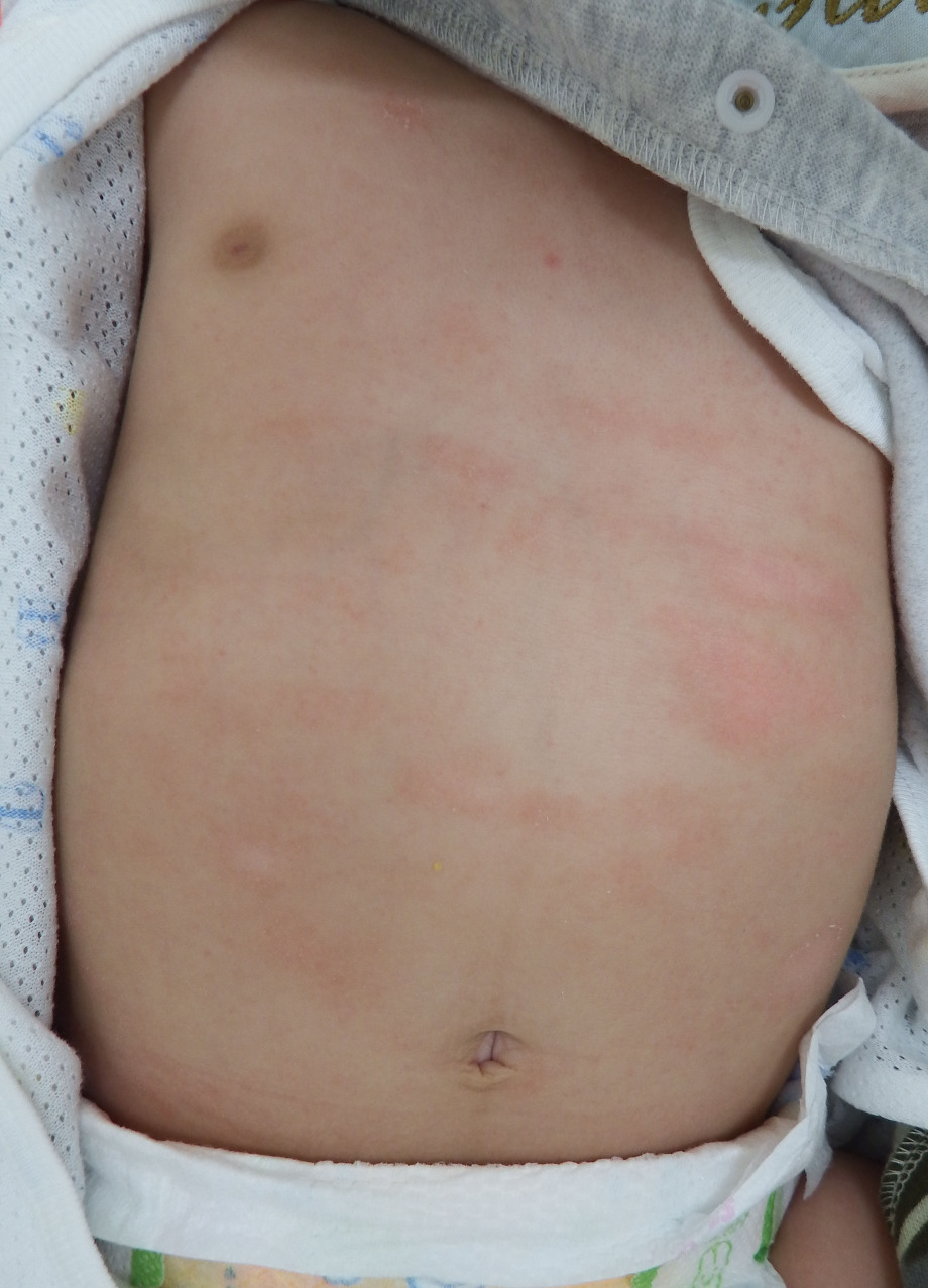 √1000以上 赤ちゃんアレルギー反応 画像 581937赤ちゃんアレルギー反応 画像