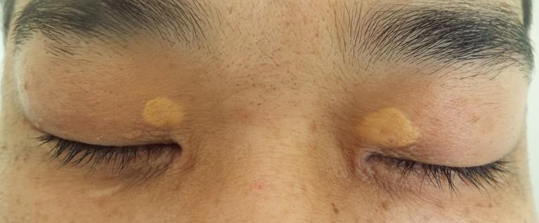 眼瞼黄色腫とは